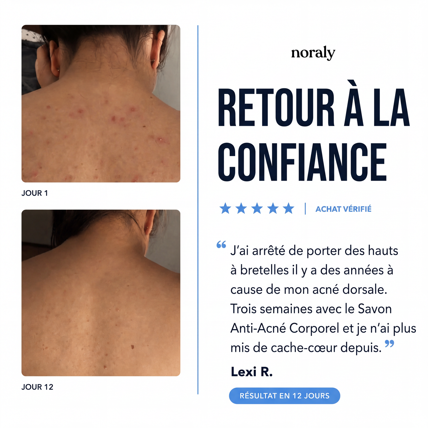 Savon Anti-Acné Corporel