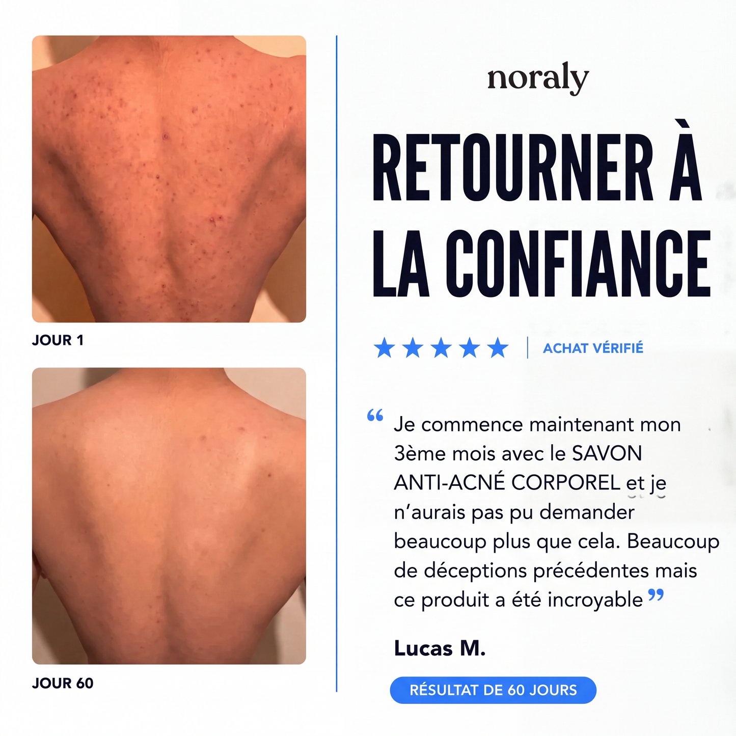 Savon Anti-Acné Corporel